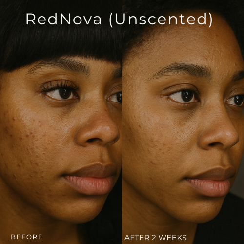 Mystiqua's RedNova™ Dark Spot Remover