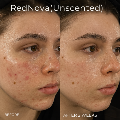 Mystiqua's RedNova™ Dark Spot Remover