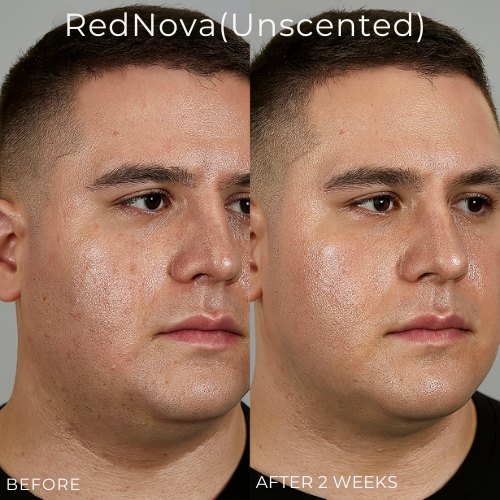 Mystiqua's RedNova™ Dark Spot Remover