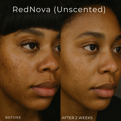 Mystiqua's RedNova™ Dark Spot Remover